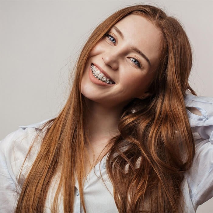Clear Braces